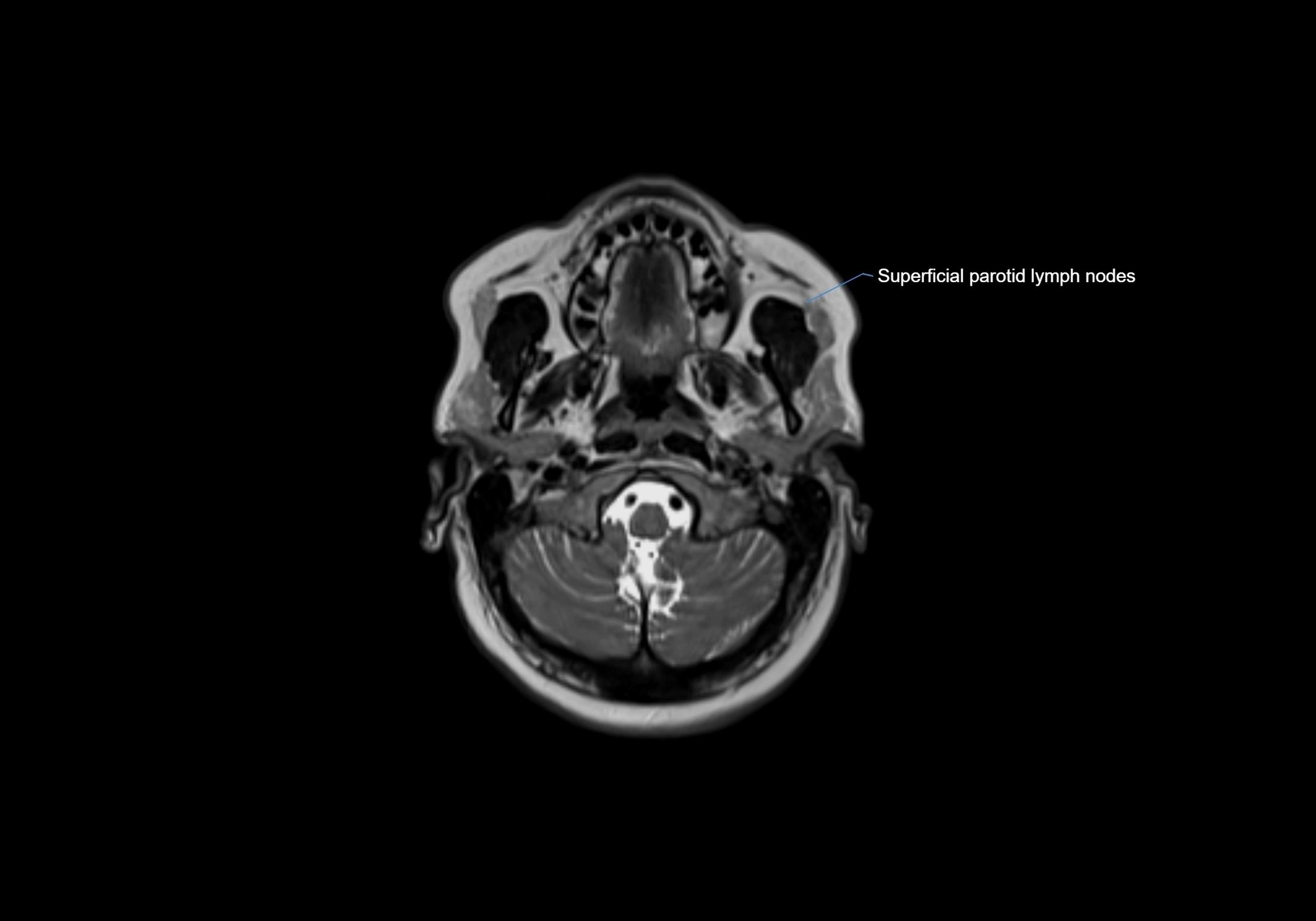 Neck axial  lymph node cross sectional MRI anatomy 3T MRI  image-img-00001-00025.webp